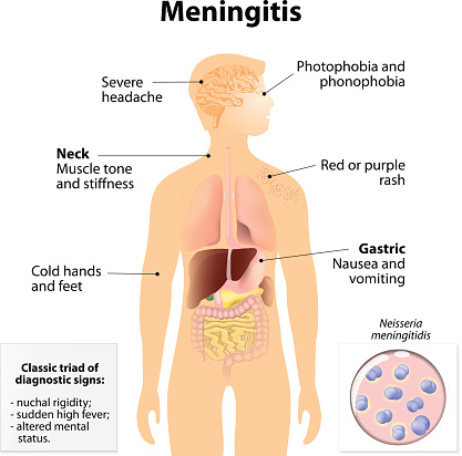 Meningitis In Adult 65