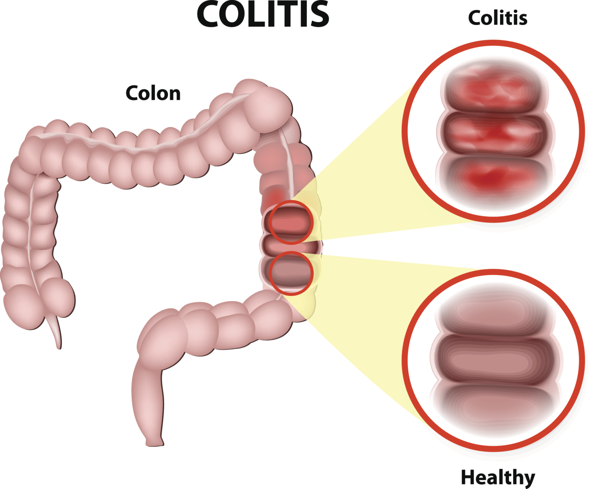 What are some common symptoms of colon inflammation?