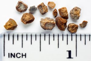 What are some of the known causes of kidney stones?