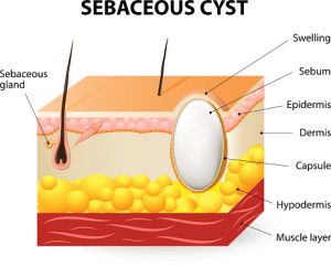 types of skin cyst #10