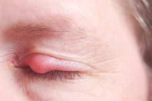 What are the symptoms of eyelid cysts?