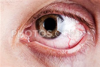 Prevent Future Eye Problems