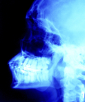 Dental X-Rays and Brain Tumors