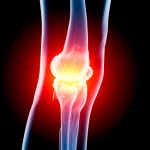 Osteoarthritis and inflammation