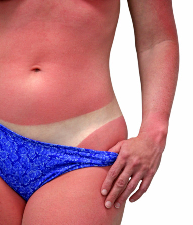 Do You Know Your Sunburn Potential?