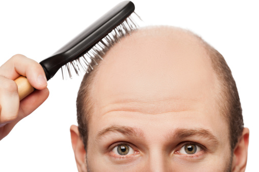 hairloss linked with heart disease