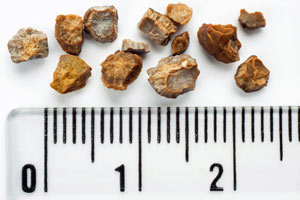 Know the signs of kidney stones