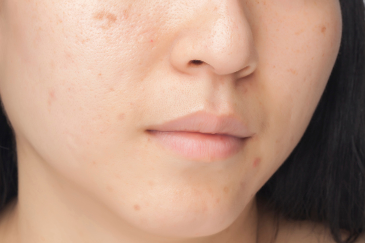 Skin fix: Natural remedies for a...