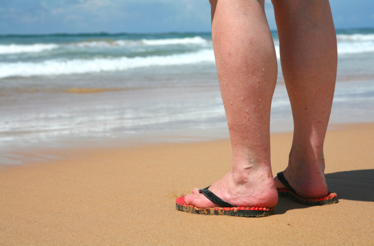 What you can do about varicose v...