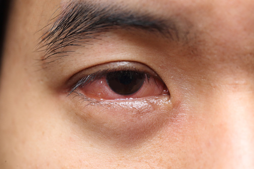 Conjunctivitis: Know about Pink eye