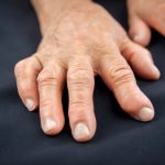 Causes of psoriatic arthritis