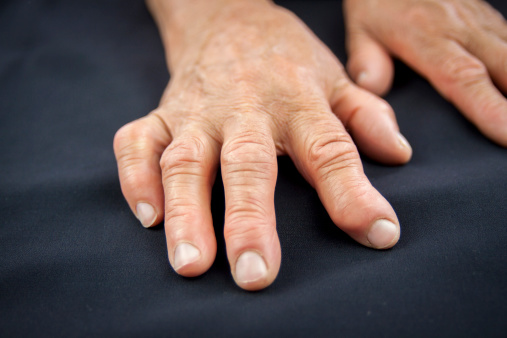 Mood affects pain in rheumatoid ...