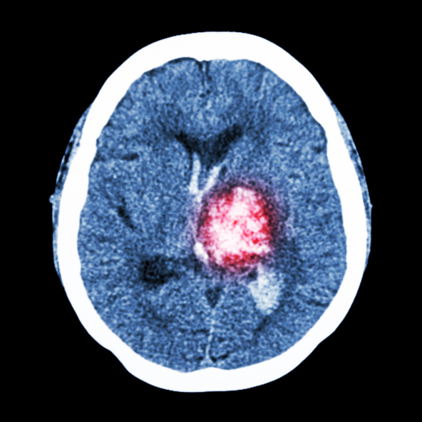 Long-term effects of stroke on m...
