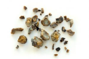 Large Kidney Stones Improve with Tamsulosin