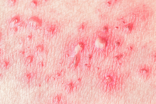 natural remedies for shingles
