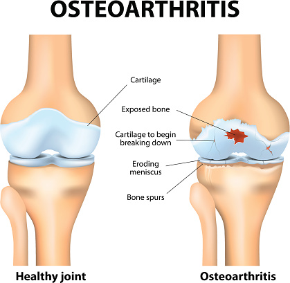 Facts about osteoarthritis