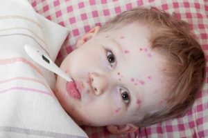 Chickenpox on the decline thanks to vaccination