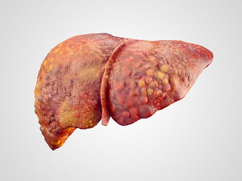 Fatty liver and diabetes risks f...