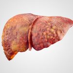 Different types of alcohol-related liver disease