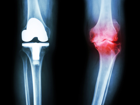 Osteoarthritis, joint replacemen...