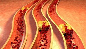 unclogged arteries with these natural remedies