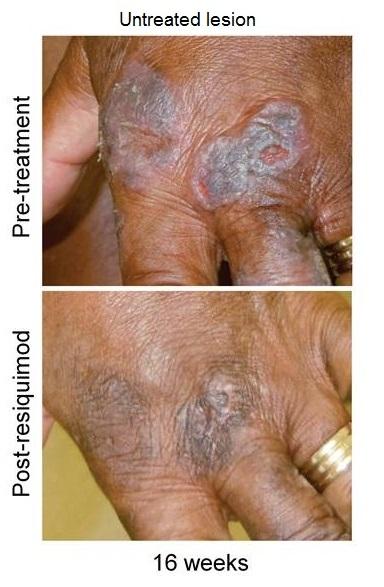 Topical gel treats T cell lymphoma