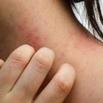 Psoriasis vs eczema