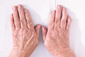 Causes and treatment for psoriatic arthritis