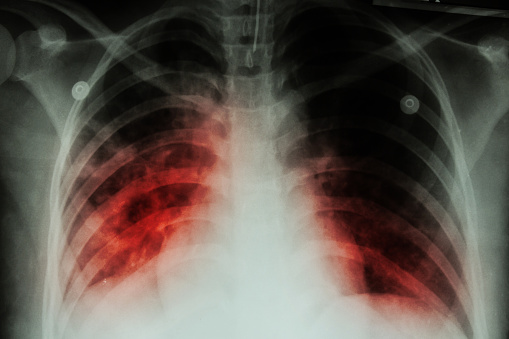 Active tuberculosis case at Univ...