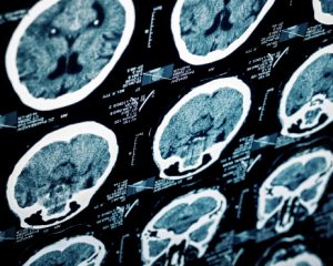 Hypertension drug blocks traumatic brain injury (TBI) inflammation caused by liver