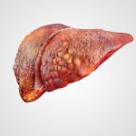 Fatty liver disease risks due to diet