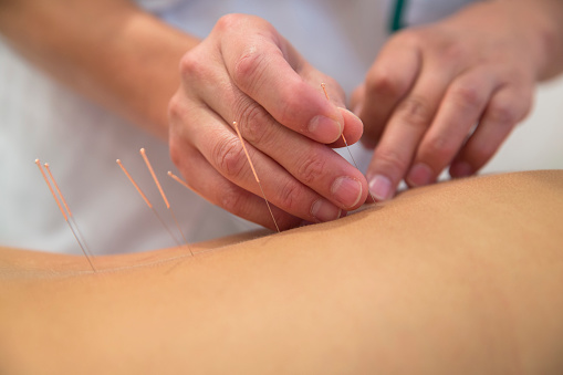 Acupuncture tops drug for back p...