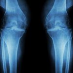 How does lupus affect the bones?