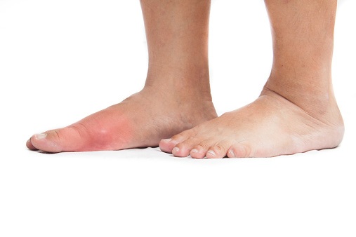 19 Natural remedies for gout pai...