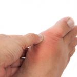 High uric acid levels and gout risk