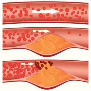 Menopause lowers good cholesterol (HDL) protection, raises atherosclerosis risk in women
