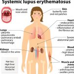 Lupus complications