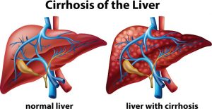 Ascites, advanced liver disease indicator for liver cirrhosis
