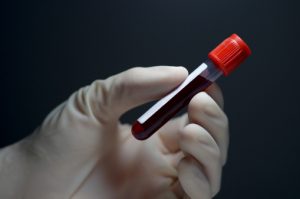 Early Alzheimer’s disease detection blood test for antibodies being developed