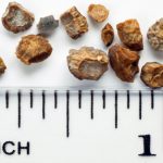 Previous study shows link between gallstone and kidney stone risk