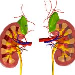 Hydronephrosis (swollen kidney) causes, symptoms and treatment