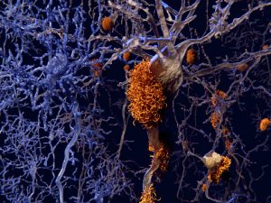 Brain’s immune system could fight off Alzheimer’s: Study
