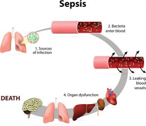 Sepsis, bacteremia and the risk of septic shock (life-threatening low blood pressure)