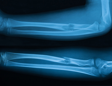 Osteonecrosis (avascular necrosi...
