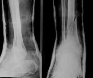 Osteoporosis treatment news roun...