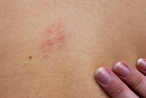 Shingles (herpes zoster) can increase heart attack risk in seniors: Study