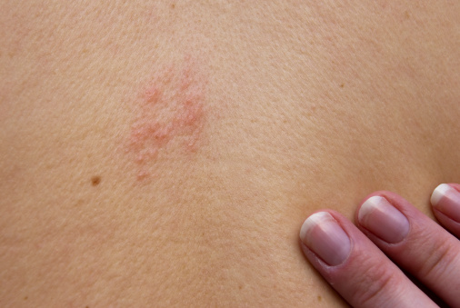 Shingles (herpes zoster) can inc...