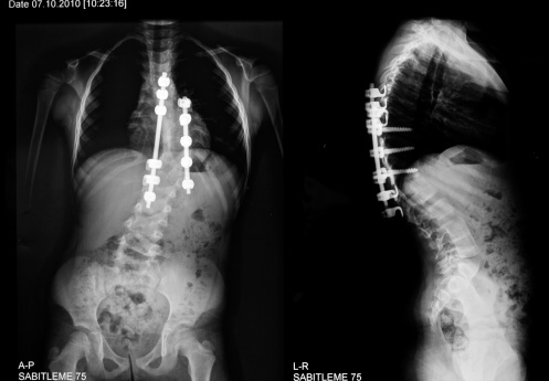 Scoliosis, an abnormal spine cur...