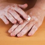 Vitiligo skin discoloration causes, symptoms and unique treatment