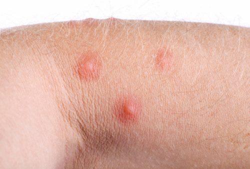 Chronic Hives Urticaria Causes Symptoms And Natural Treatment